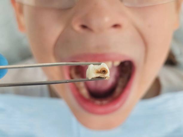 Best Broken or Cracked Tooth Emergency Dentist in Old Bethpage, NY